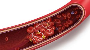 Nattokinase phá tan cục máu đông, tăng cường lưu thông mạch máu
