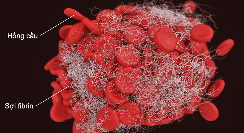 Nattokinase có khả năng làm tan sợi huyết (fibrin)