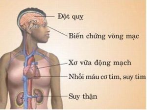 Hậu quả của cao huyết áp