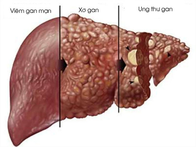 Các biến chứng về sau